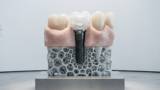 implantes-dentarios-em-bc
